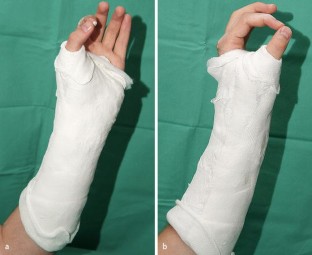 Frakturen des Handgelenks und der Hand | SpringerLink