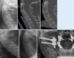 Verletzungen der oberen Halswirbelsäule | SpringerLink