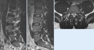 Degenerative Erkrankungen der Wirbelsäule SpringerLink