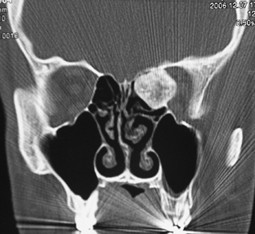 Radiologische Diagnostik der Nasennebenhöhlen | SpringerLink