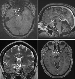 Hypophysentumoren | SpringerLink