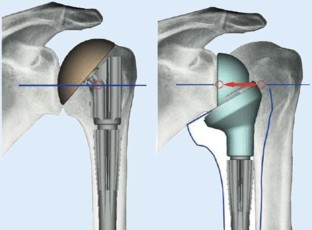 Inverse Schulterprothese Bungen