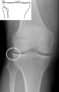 Symptomatic torn discoid lateral meniscus in adults | SpringerLink