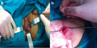tape transobturator fistula erosion complication procedure