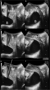 What is normal bladder neck anatomy? | SpringerLink