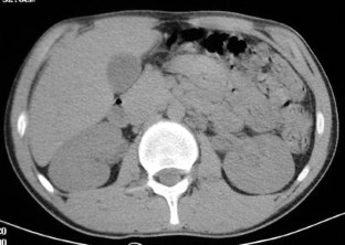 biliary nephrolithiasis ceftriaxone