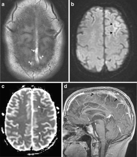 Cerebral sinovenous thrombosis in pediatric practice | SpringerLink