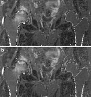 fig edema marrow bone hip