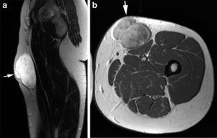 MRI of superficial soft tissue masses: analysis of features useful in ...