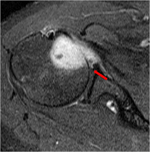 MRI characteristics of nodular fasciitis of the musculoskeletal system ...