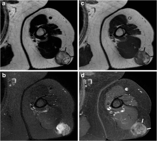 Encapsulated fat necrosis mimicking subcutaneous liposarcoma ...