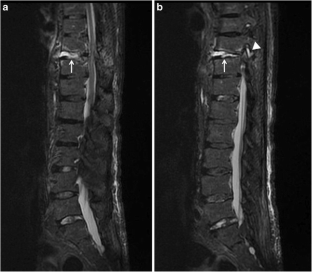CT- and fluoroscopy-guided percutaneous screw fixation of ...