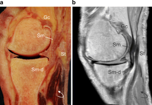 Distal insertions of the semimembranosus tendon: MR imaging with