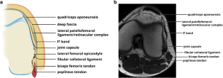The iliotibial tract: imaging, anatomy, injuries, and other pathology