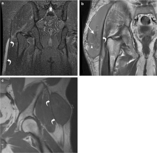 The iliotibial tract: imaging, anatomy, injuries, and other pathology