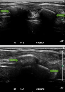 Misplaced Rib Dynamic ultrasound in the evaluation of patients with suspected ...