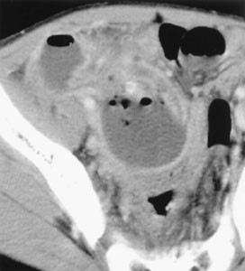 Gastrointestinal tract perforation: CT diagnosis of presence, site, and ...