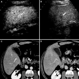Hepatocellular nodules in liver cirrhosis: contrast-enhanced ultrasound ...