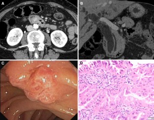 MDCT and MRI of the ampulla of Vater (part I): technique optimization