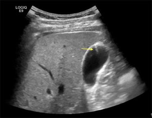 Comet-tail artifact in adenomyomatosis | SpringerLink