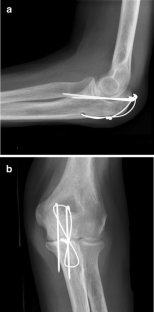 Ao tension band osteosynthesis of displaced olecranon fractures 08 picture