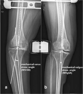 Varus-valgus stress radiograph as a predictor for extensive medial ...