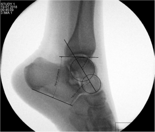 lengthening calcaneus osteotomy limitations lower