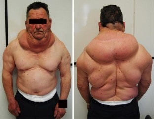 Madelung’s Disease: Comorbidities, Fatty Mass Distribution, and