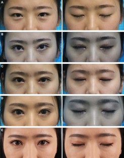 Supraciliary Incision as a New Double-Eyelid Approach for Asian ...