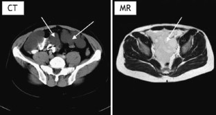 Benign Peritoneal Cystic Mesothelioma | SpringerLink