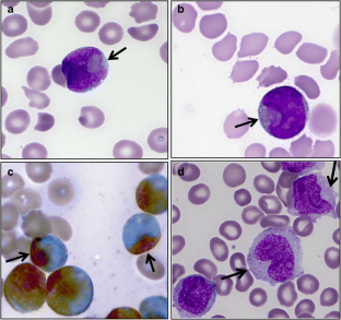 Association of cup-like nuclei in blasts with FLT3 and NPM1 mutations ...