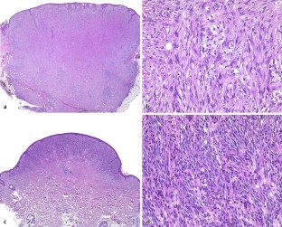 Best option for desmoplastic melanoma