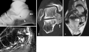 Accessory ossicles and sesamoid bones of the ankle and foot: imaging ...