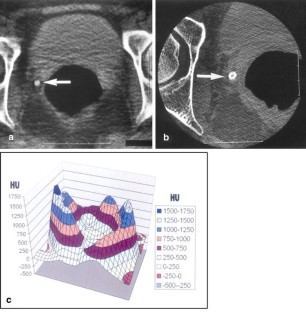 Distinguishing Pelvic Phleboliths From Distal Ureteral Calculi Thin distinguishing-pelvic-phleboliths-from-distal-ureteral-calculi-thin