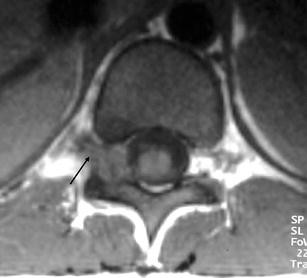 Imaging Features Of Spinal Osteoid Osteoma With Emphasis On Mri 