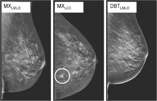 Tomosynthesis rafferty 2008 04 picture