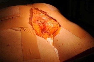 before and after stapled hemorrhoidectomy before and after stapled hemorrhoidectomy