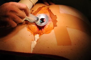stapled hemorrhoidectomy stapled hemorrhoidectomy