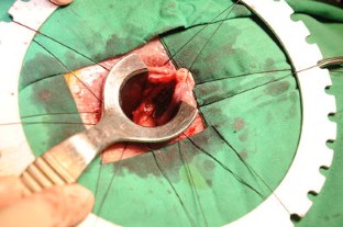 before and after stapled hemorrhoidectomy before and after stapled hemorrhoidectomy