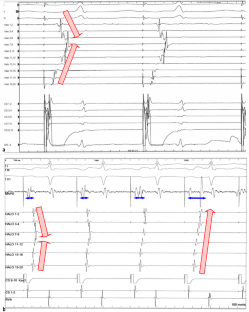Typisches Vorhofflattern | SpringerLink