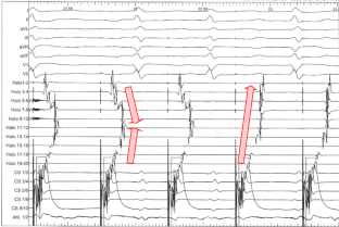 Typisches Vorhofflattern | SpringerLink
