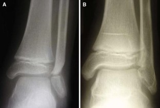 Premature closure of distal fibular growth plate: a case of