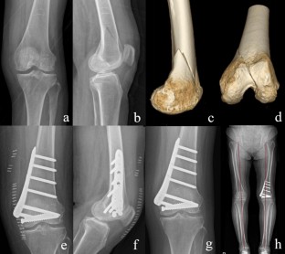 Characteristics of medial condyle sagittal fracture of distal femur