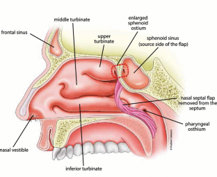 cerebrospinal fluid leak causes cerebrospinal fluid leak causes
