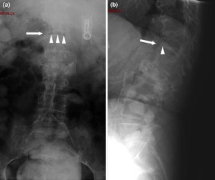 Kummell’s disease: delayed post-traumatic osteonecrosis of the ...