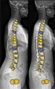 Correction of hypokyphosis in thoracic adolescent idiopathic scoliosis