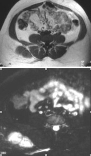 Enthesopathy causes image