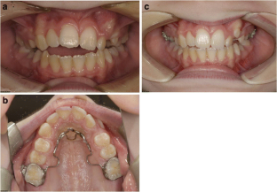 Orthodontic treatment of anterior open bite: a review article—is ...