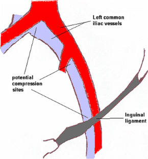 Spontaneous Iliac Vein Rupture: Case Report and Comprehensive Review of ...