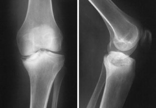 Charcot Joint Case Study